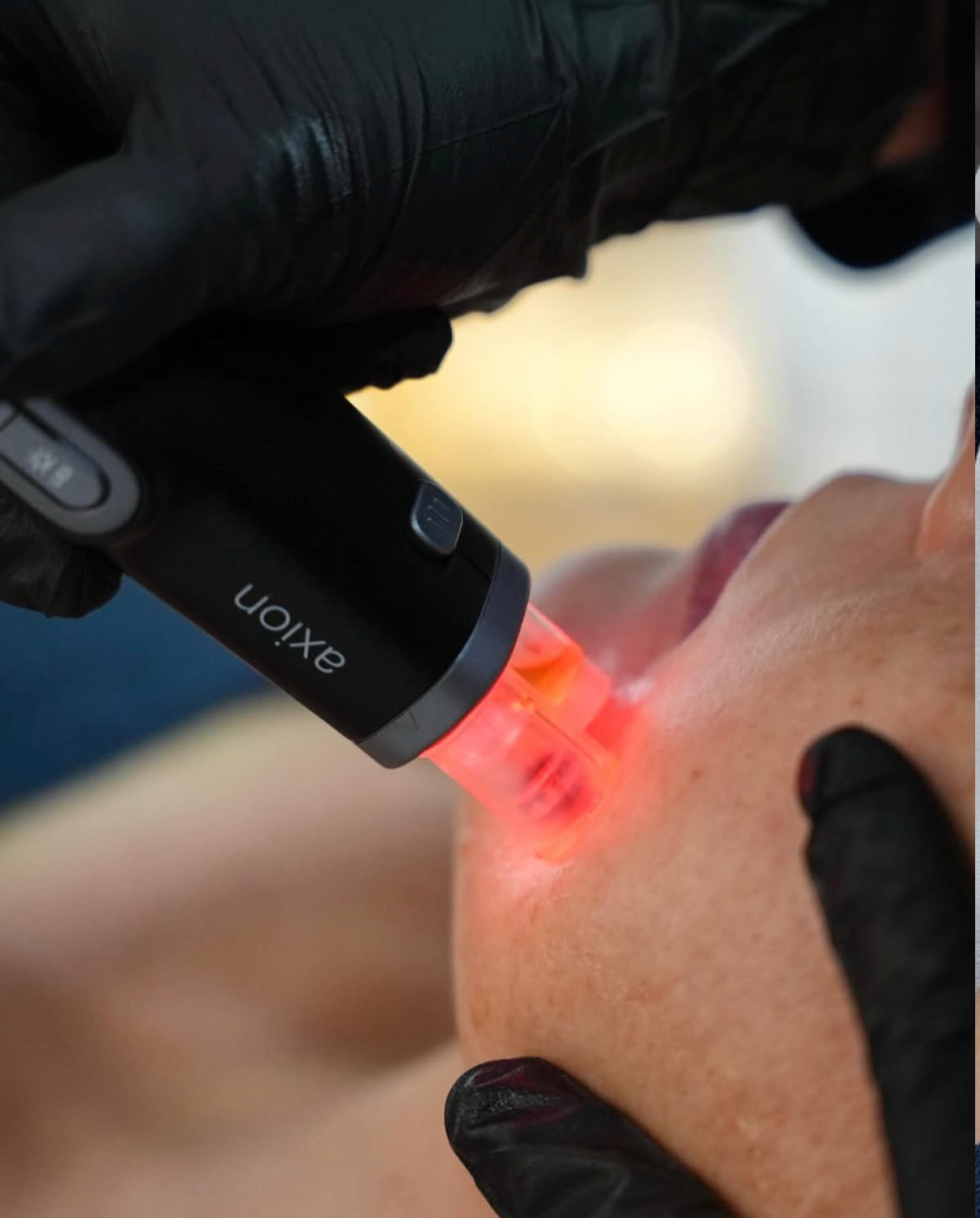 AXION Microneedling