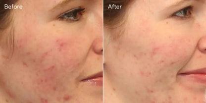 Acne Control Clarifying Cleanser