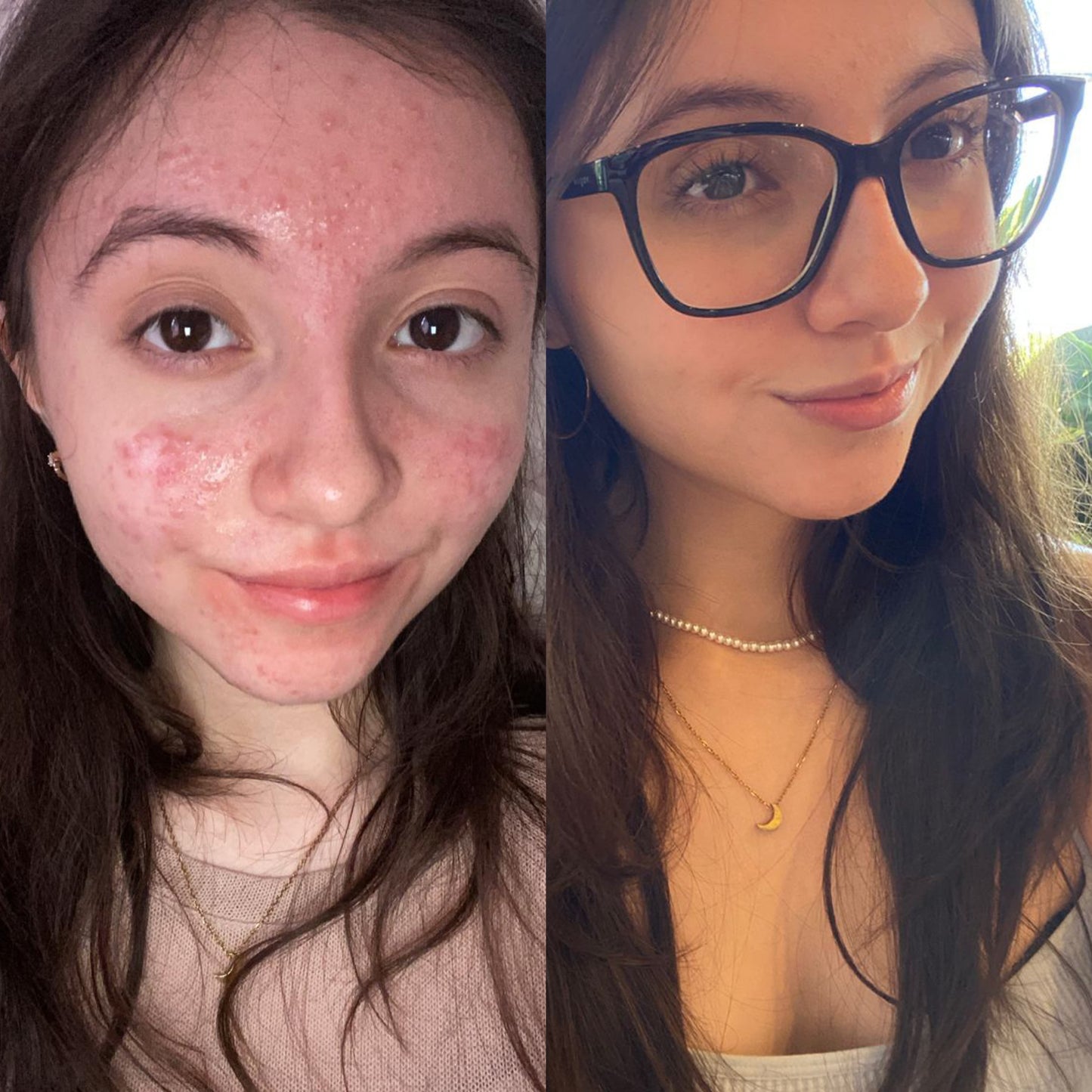Facial Teens