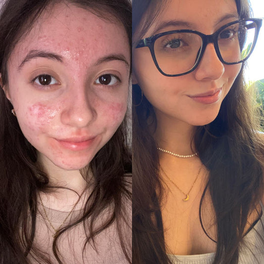 Facial Teens